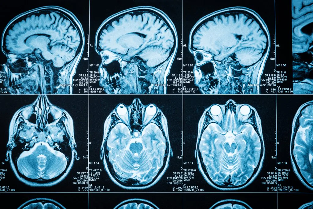 Types of Traumatic Brain Injuries (TBIs)