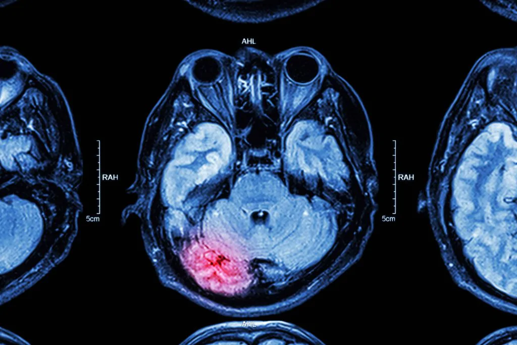 Types of Traumatic Brain Injuries: What You Should Know